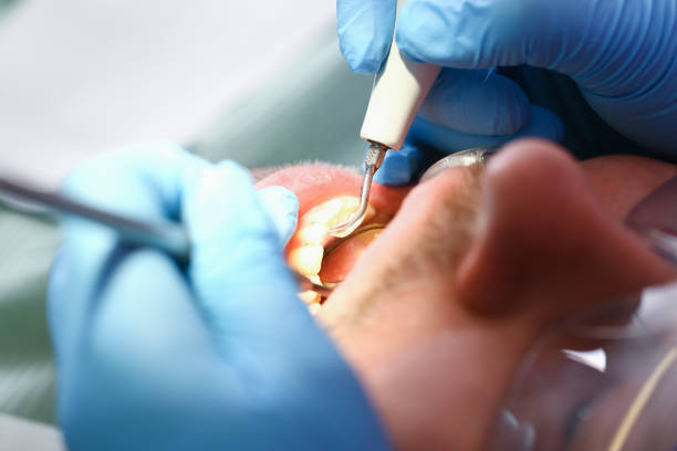 Best Emergency Dental Care for Abscessed Tooth in Woodbury, NJ